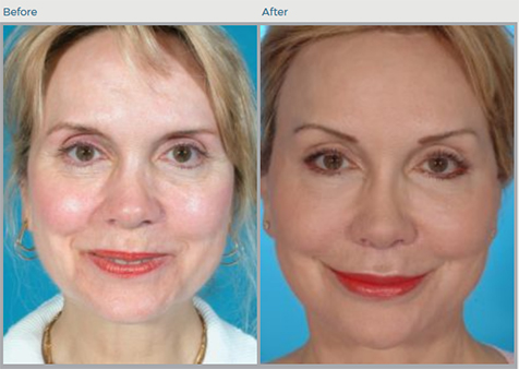 Forehead Lift Before and After Pictures Boca Raton, FL