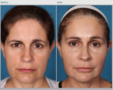 Forehead Lift Before and After Pictures Boca Raton, FL
