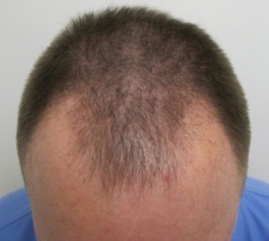 Men Hair Loss | Daniel Man MD | SmartGraft | Boca Raton, FL
