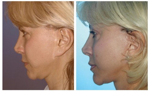 Facelift Before and After Pictures in Boca Raton, FL
