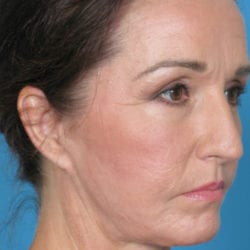 01after-eco-laser-dr-daniel-man-kabside1-jpg