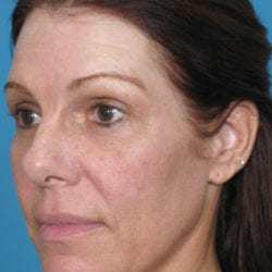 01after-eyelid-lift-dr-daniel-man-sumeside2-jpg