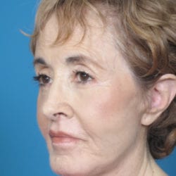 01after-face-lift-dr-daniel-man-elboside1-jpg