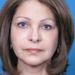 01after-face-lift-dr-daniel-man-elfront-jpg