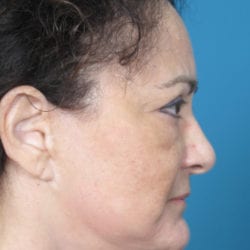 01after-face-lift-dr-daniel-man-fpside-jpg