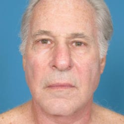 01after-face-lift-dr-daniel-man-jffront-jpg