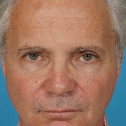 01after-face-lift-dr-daniel-man-jffront1-jpg