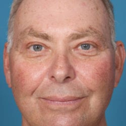 01after-face-lift-dr-daniel-man-jmfront1-1-jpg