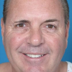 01after-face-lift-dr-daniel-man-mffront-jpg