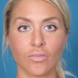 01after-face-lift-dr-daniel-man-rwfront1-jpg