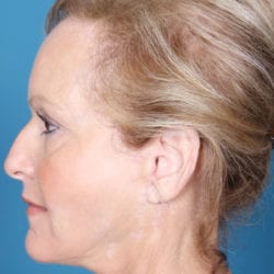 01after-face-lift-dr-daniel-man-shslside2-jpg