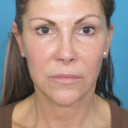 01after-face-lift-dr-daniel-man-stsside1-jpg