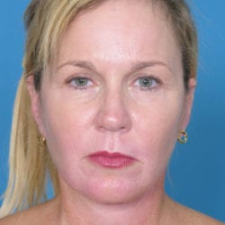 01after-face-lift-dr-daniel-man-vidfront1-1-jpg