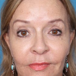 01after-fafrfront1-jpg