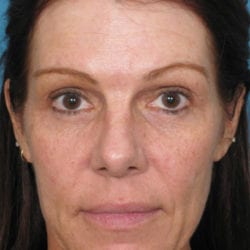 01after-forehead-lift-dr-daniel-man-sumefront1-jpg