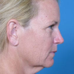 01before-vdside1-jpg