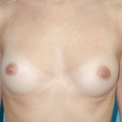 01before-breast-enlargement-dr-daniel-man-rrfront2-jpg