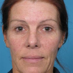 01before-eco-laser-dr-daniel-man-sumefront1-jpg