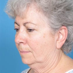 01before-face-lift-dr-daniel-man-cdside1-jpg