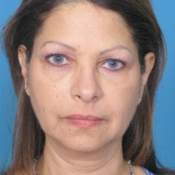 01before-face-lift-dr-daniel-man-elfront-jpg