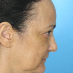 01before-face-lift-dr-daniel-man-fpside-jpg