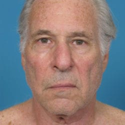 01before-face-lift-dr-daniel-man-jffront-jpg