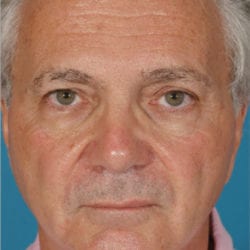 01before-face-lift-dr-daniel-man-jffront1-jpg