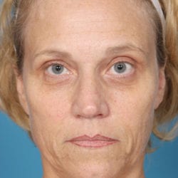 01before-face-lift-dr-daniel-man-kielfront1-jpg