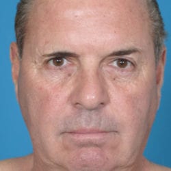 01before-face-lift-dr-daniel-man-mffront-jpg