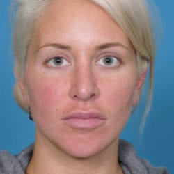 01before-face-lift-dr-daniel-man-rwfront1-jpg