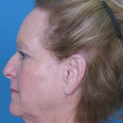 01before-face-lift-dr-daniel-man-shslside2-jpg