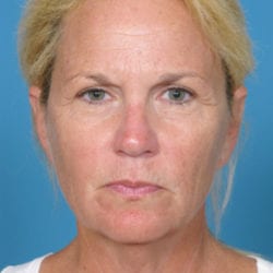 01before-face-lift-dr-daniel-man-vidfront1-1-jpg