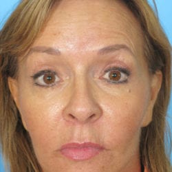 01before-fafrfront1-jpg