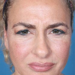 01before-ormifront1-jpg