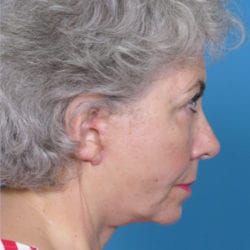 02after-face-lift-dr-daniel-man-cdside2-jpg