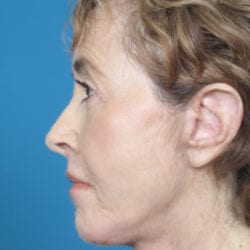 02after-face-lift-dr-daniel-man-elboside2-jpg