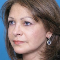 02after-face-lift-dr-daniel-man-elside1-jpg