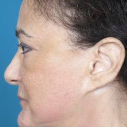 02after-face-lift-dr-daniel-man-fpside1-jpg