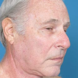 02after-face-lift-dr-daniel-man-jfside1-jpg