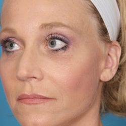 02after-face-lift-dr-daniel-man-kielside1-jpg