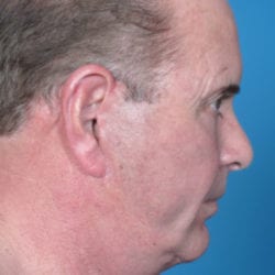 02after-face-lift-dr-daniel-man-mfside-jpg