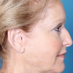 02after-face-lift-dr-daniel-man-ssside1-jpg