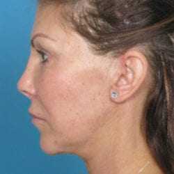 02after-face-lift-dr-daniel-man-stsside1-jpg