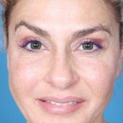 02after-ormifront2-jpg