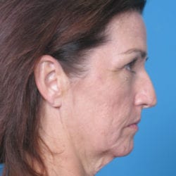 02before-eco-laser-dr-daniel-man-kabside2-jpg