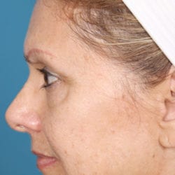 02before-face-lift-dr-daniel-man-dobuside5-jpg