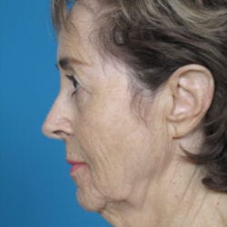 02before-face-lift-dr-daniel-man-elboside2-jpg