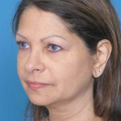 02before-face-lift-dr-daniel-man-elfront-jpg