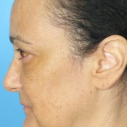 02before-face-lift-dr-daniel-man-fpside1-jpg