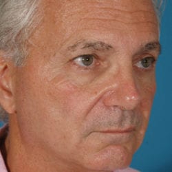 02before-face-lift-dr-daniel-man-jfside1-1-jpg